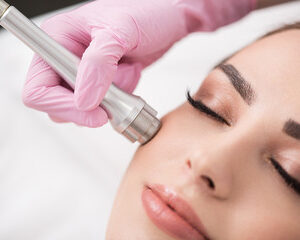  dermabrasion