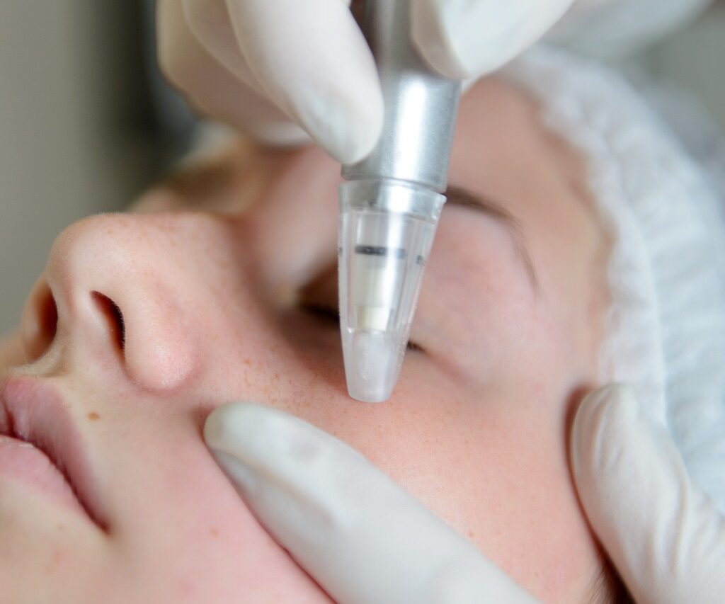 microdermabrasion