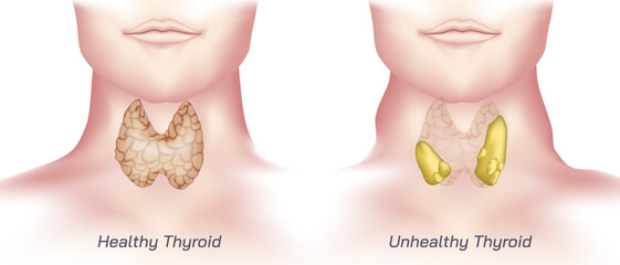 problèmes de thyroïde