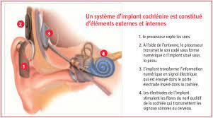 implant cochléaire